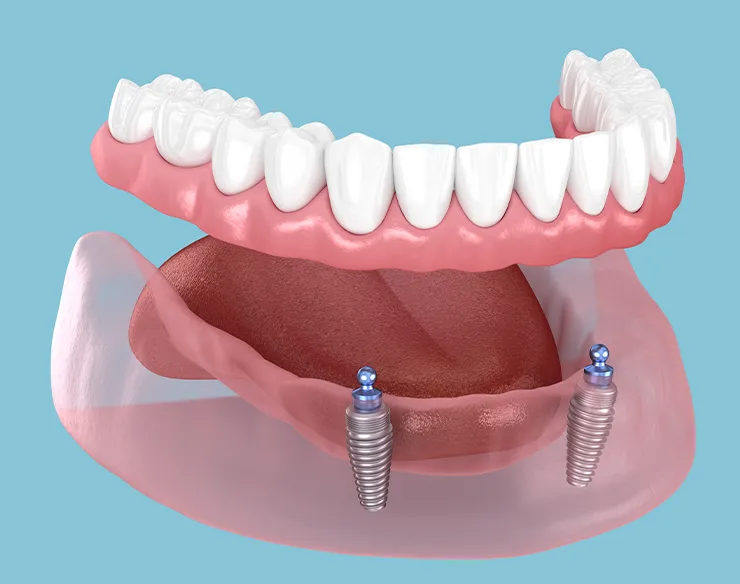 prosthetic dentistry , dental prosthesis , dental prosthesis in Mortsel , prosthetic dentistry in Mortsel