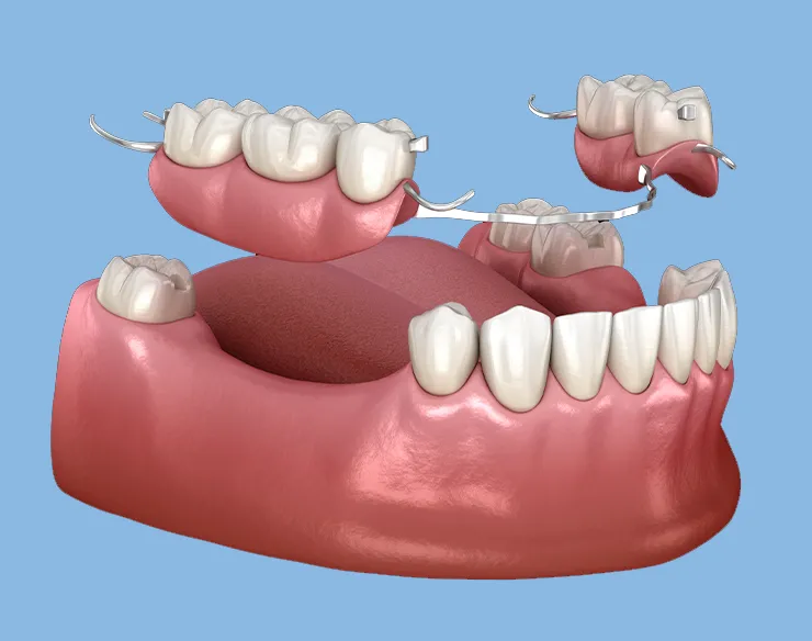 prosthetic dentistry , dental prosthesis , dental prosthesis in Mortsel , prosthetic dentistry in Mortsel