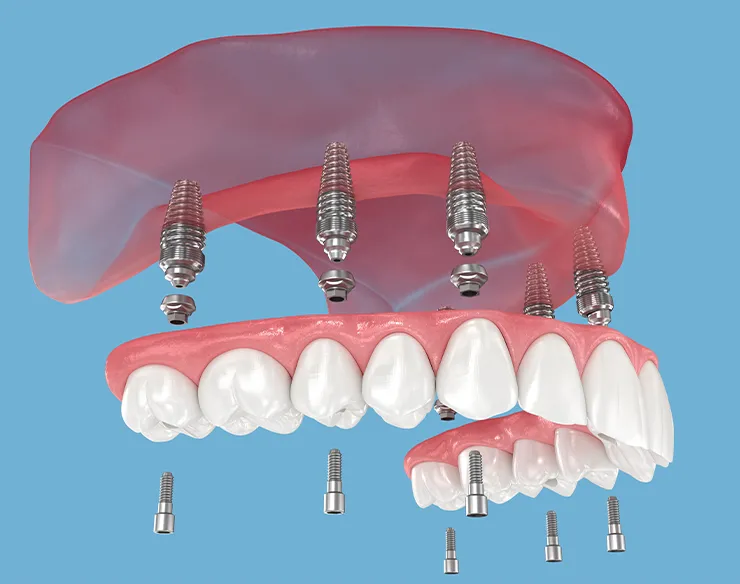 prosthetic dentistry , dental prosthesis , dental prosthesis in Mortsel , prosthetic dentistry in Mortsel