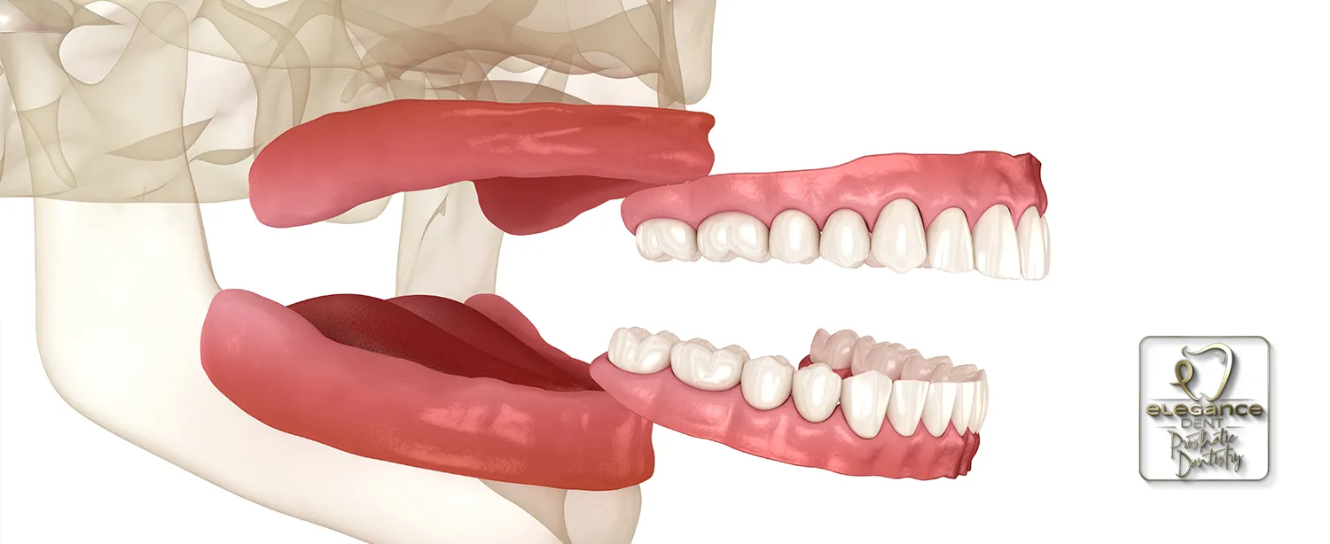prosthetic dentistry , dental prosthesis , dental prosthesis in Mortsel , prosthetic dentistry in Mortsel