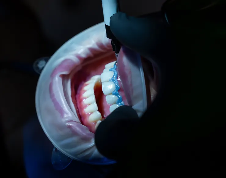 Teeth Whitening , Safe Teeth Whitening in Mortsel