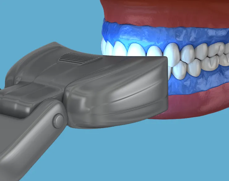 Teeth Whitening , Safe Teeth Whitening in Mortsel