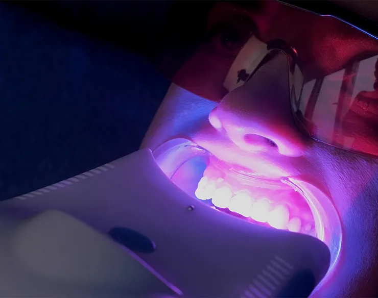 Teeth Whitening , Safe Teeth Whitening in Mortsel