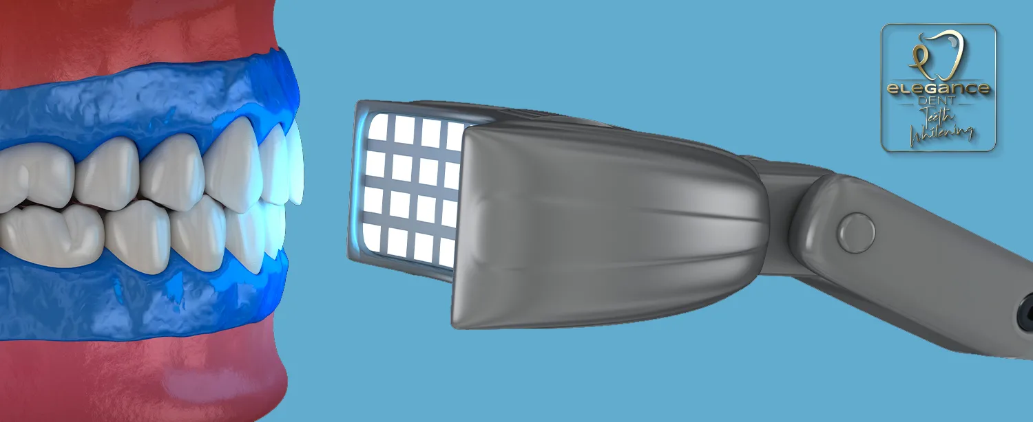 Teeth Whitening , Safe Teeth Whitening in Mortsel