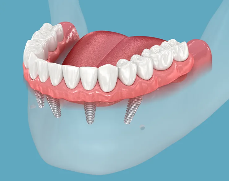 implant, dental implant, all on four , implant in Mortsel Belgium
