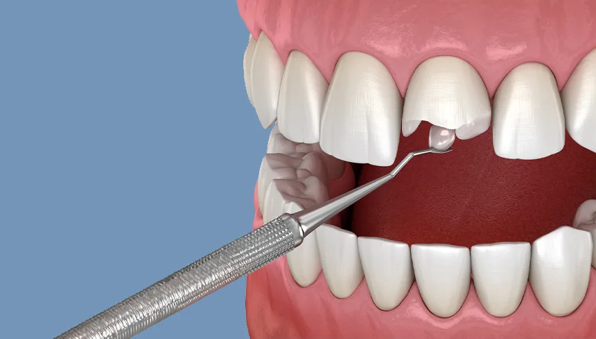 dental restoration, dental fillings , Fillings in Mortsel Belgium