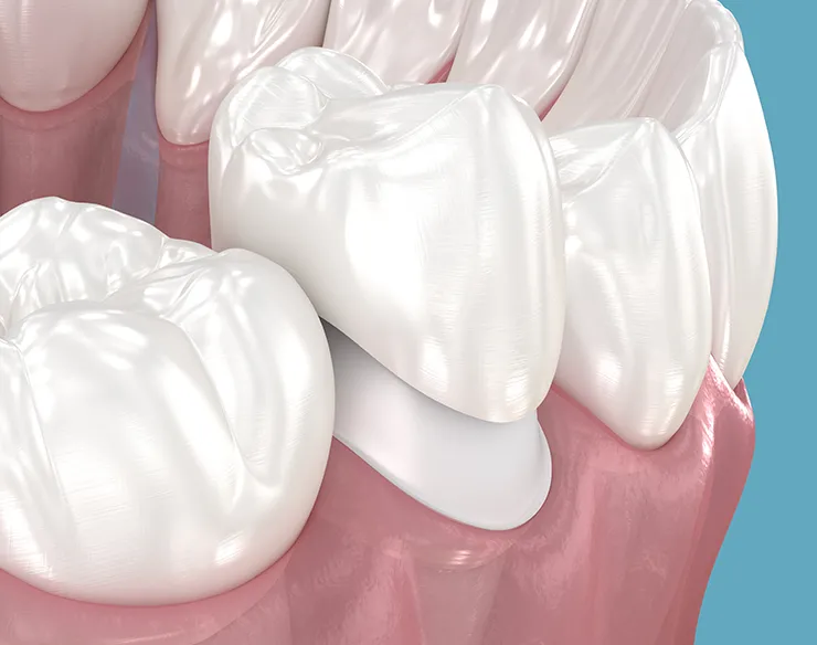 porcelain crowns, Zirconia Crowns , dental porcelain crowns, porcelain crowns in Mortsel Belgium , Zirconia Crowns in Mortsel Belgium ,