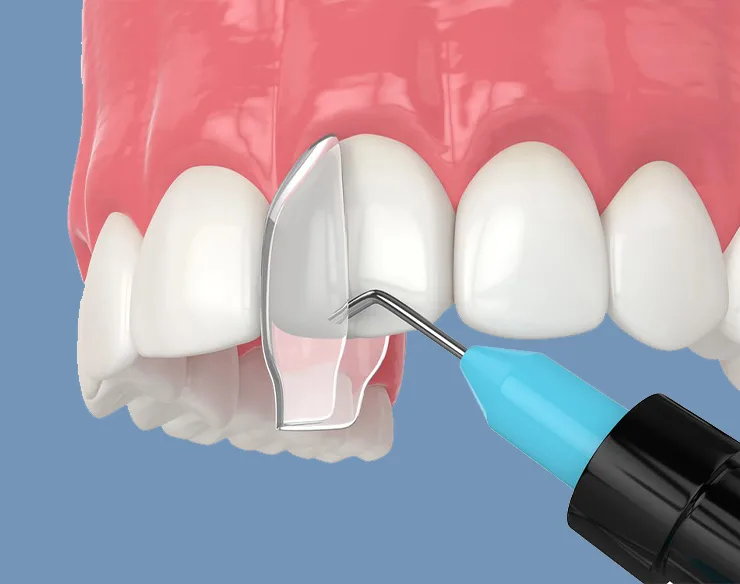 dental restoration, dental fillings , Fillings in Mortsel Belgium