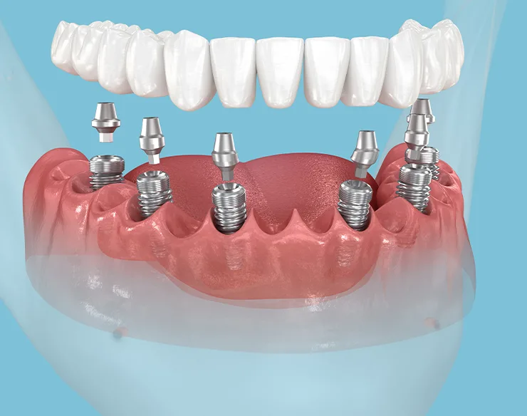 implant, dental implant, all on four , implant in Mortsel Belgium