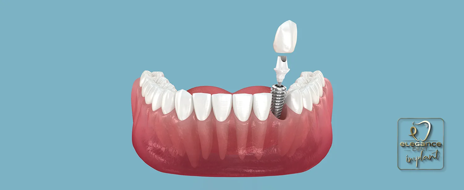 implant, dental implant, all on four , implant in Mortsel Belgium