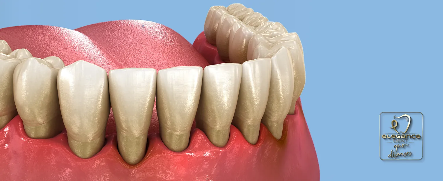 gum diseases, Gingivitis , Periodontitis , gum diseases in Mortsel