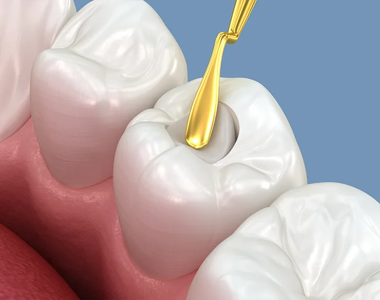 dental restoration, dental fillings , Fillings in Mortsel Belgium