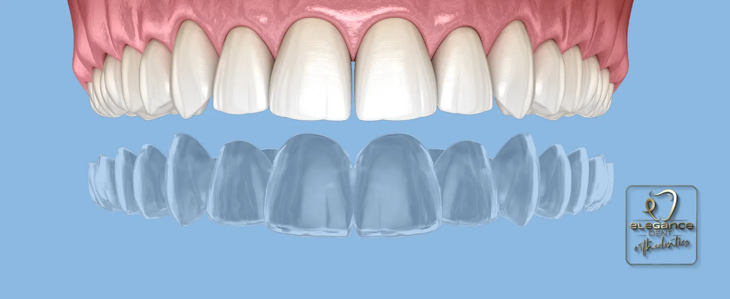 Orthodontics , Invisalign , Orthodontics Treatments in Mortsel , Invisalign Treatments in Mortsel