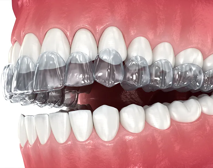 Orthodontics , Invisalign , Orthodontics Treatments in Mortsel , Invisalign Treatments in Mortsel