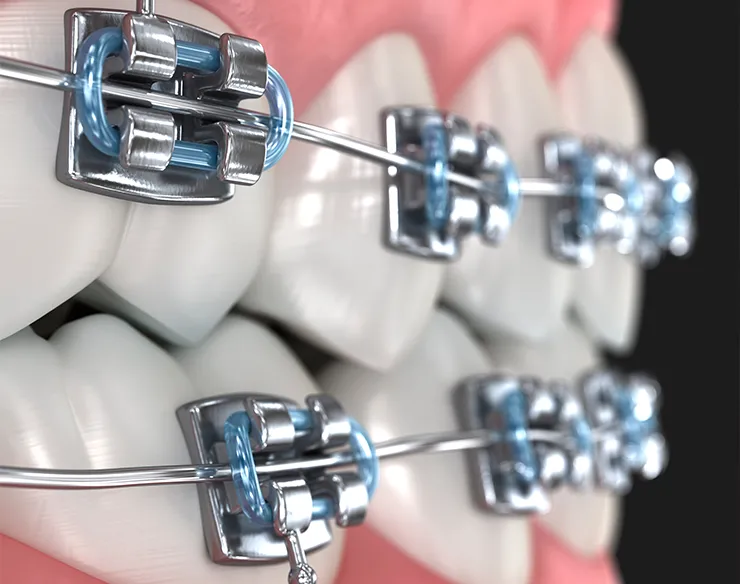 Orthodontics , Invisalign , Orthodontics Treatments in Mortsel , Invisalign Treatments in Mortsel