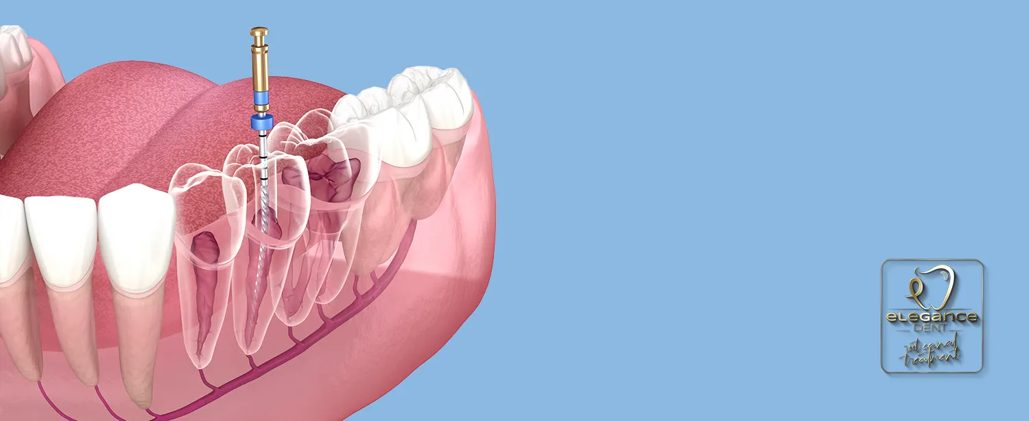 Root Canal Treatment , Dental Root Canal Treatment , Root Canal Treatment in Mortsel Belgium