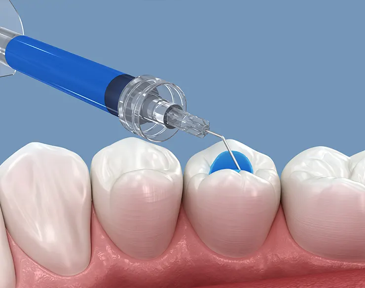 Root Canal Treatment , Dental Root Canal Treatment , Root Canal Treatment in Mortsel Belgium