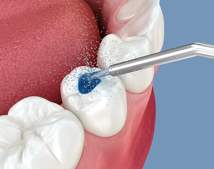 Root Canal Treatment , Dental Root Canal Treatment , Root Canal Treatment in Mortsel Belgium