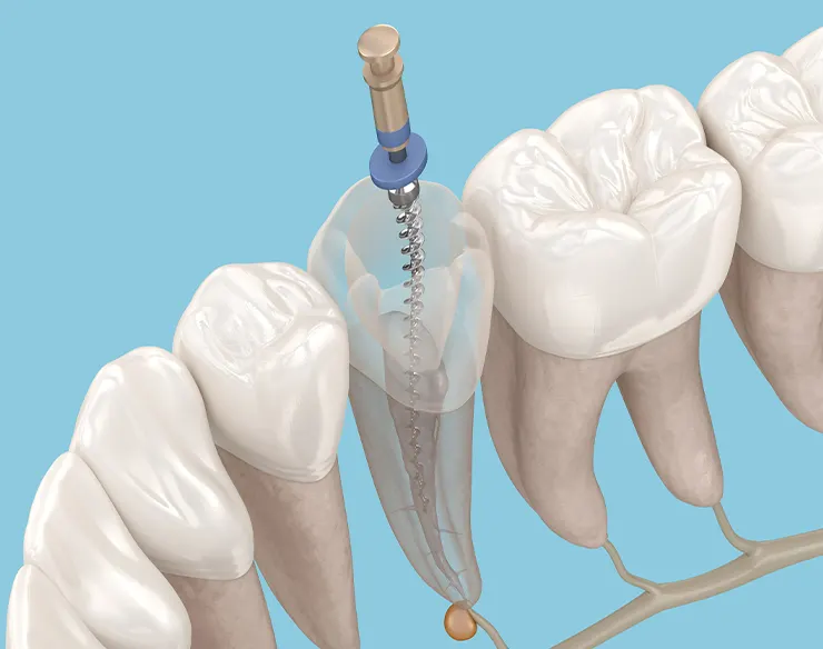 Root Canal Treatment , Dental Root Canal Treatment , Root Canal Treatment in Mortsel Belgium