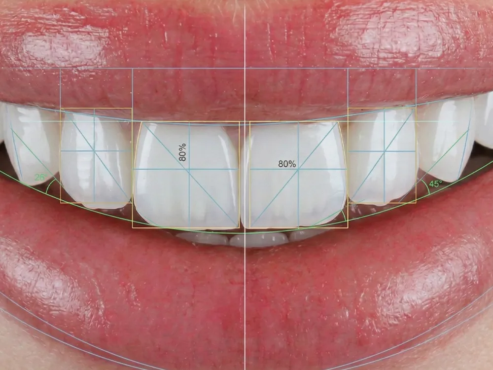 Smile design , smile design Mortsel