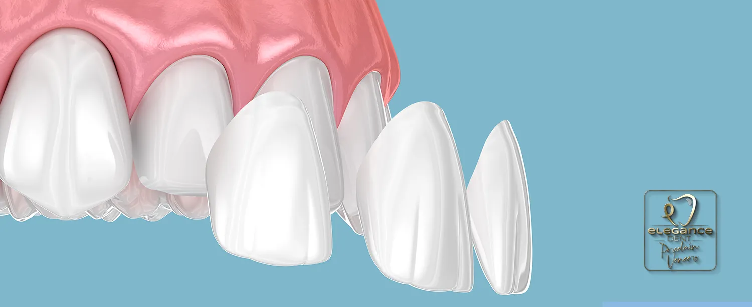 veneers, dental veneers , porcelain veneers , veneers , in Mortsel