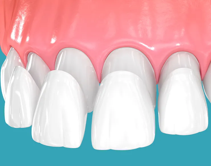 veeners , dental veeners , laminate veeners , veeners in Mortsel