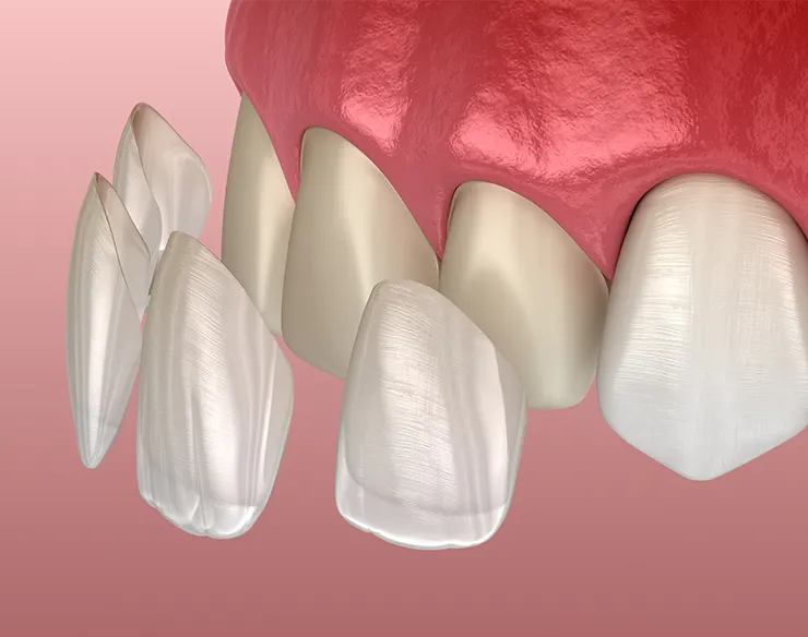 veeners , dental veeners , laminate veeners , veeners in Mortsel