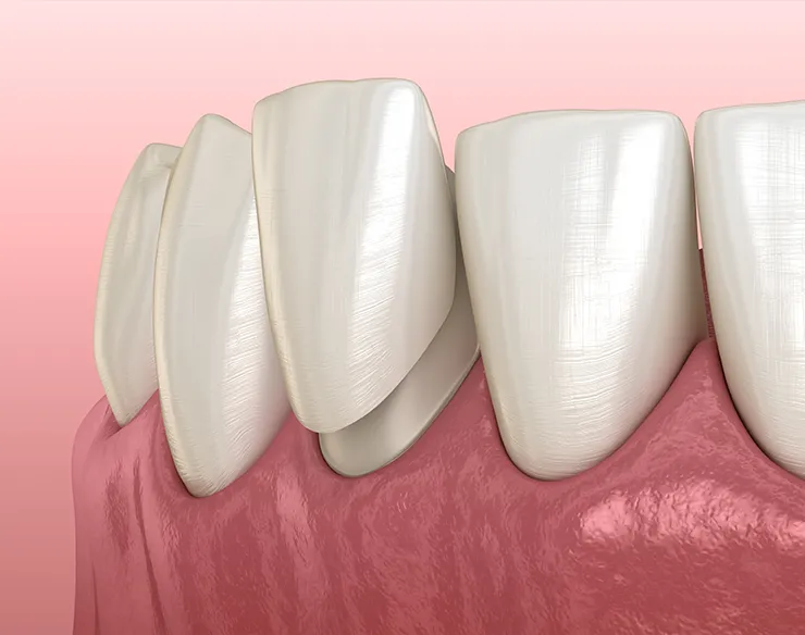 veeners , dental veeners , laminate veeners , veeners in Mortsel